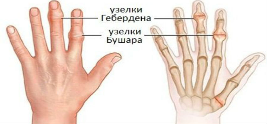 Диета При Артрите Пальцев Рук