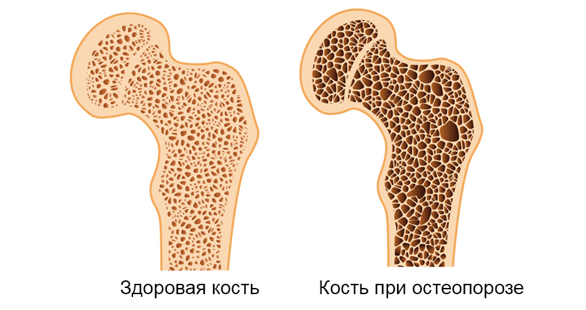 Здоровая кость Кость при остеопорозе.jpg