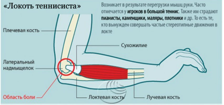 Латеральный эпикондилит - Латеральный эпикондилит Foto 19