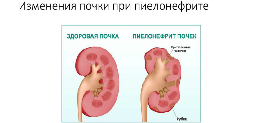 Нефрит болезнь