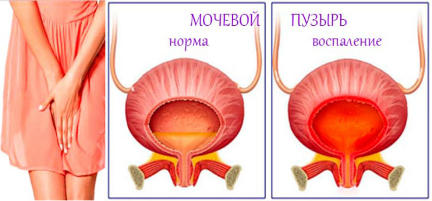 Хронический цистит моча