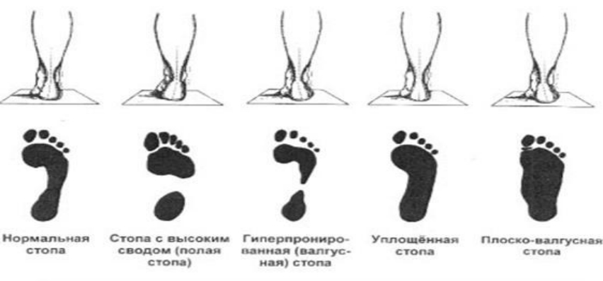 Тейпирование при вальгусе у детей схема