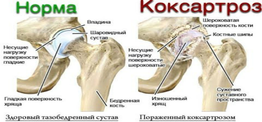 Коксартроз код