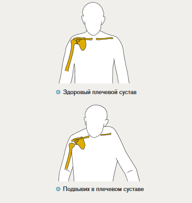 Не поднимается рука в плечевом суставе. Мобильность плечевого сустава. Правильное положение плечевого сустава. Плечо болит рука не поднимается.