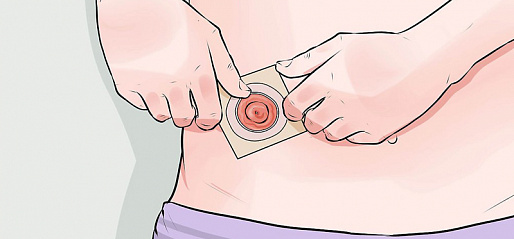 Популярные вопросы о кишечной стоме